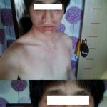 (사진有)변때문에 변한 내 얼굴