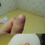 이런 손톱병이 생겼어요.ㅜㅜ(사진有)