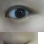 <b>쌍꺼풀</b>수술의 오해로인한 비극(인증)