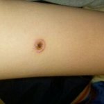 (사진有) 빙초산으로 점빼려다 흉지게생겼어요