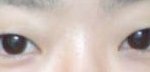 <b>쌍</b>커풀수술 할까요 ㅠㅠ
