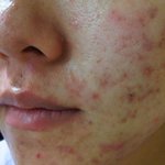 여드름 자국 투성이 얼굴.. 저는 이렇게 화장해요 ㅋㅋㅋㅋ