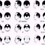 탈모의 계절 가을, 탈모증상이 보이면 바로 병원으로 가라네요