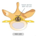 세대별로 주로 나타나는 척추질환(디스크, 척추관협착증 등)에 대하여~ 