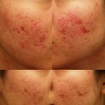 우둘두둘 시뻘건 내 피부. 지금은 치료중...