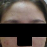 여드름때문에 면접 떨어졌습니다.(사진첨부)