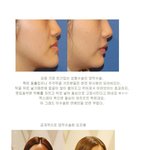 <b>양악</b>수술전후 연예인