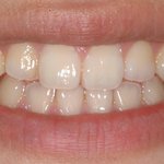 (사진有) 연예인이 많이한다는 <b>양악</b>수술후 부작용이 생겼어요!!!ㅠㅠ