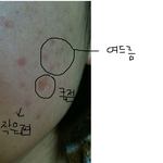 점뺀 <b>흉터</b> 용기내서 올립니다. 도와주세요 ㅜㅜ