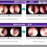 추운날씨와 <b>비염</b>때문에 고생하시는 분들을 위해~