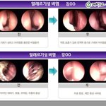 춥고 건조한 겨울~!! <b>비염</b>걱정없이 보내는 비법