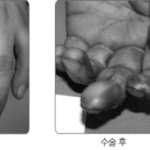 일하다가 손가락 절단된사연..,