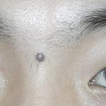 <b>저</b> 흉칙한 점을 뺄까요 말까요(<b>사진</b> 有)