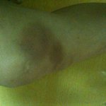 연습하다 다리에 멍든 엠블랙 미르