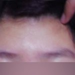 좁은 이마넓히려다가 망한 여자후기有 (약간혐오,수정)