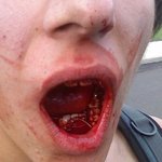 호주워킹중 싸워서 큰일났습니다..도와주세요