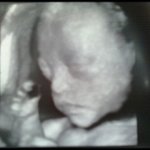 <b>정밀</b> 초음파에 대한 개인적 의견...