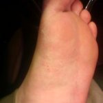 습진 걸리면은 증상이 어떤가요?