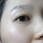 <b>좁쌀</b> 여드름 성공기