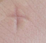 ★★★★★ 모기물렸을때 공감 ★★★★★