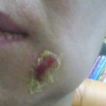 제모중 <b>화상</b> 어떻게 할까요?(사진有)