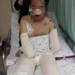 병원에서 의료사고로 친구의 친구아버지 팔다리와 코를 잘라냈습니다...