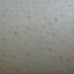 모공각화증있는 언니들있어 ?? ㅜㅠ
