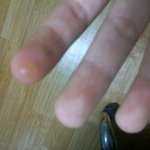 [사진有] 손가락좀 봐주세요 ! 정체가 뭘까요 ㅠㅠ