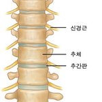 ★허리디스크짊어진 남