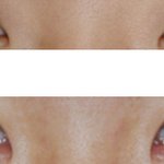 쌍수 후기 ㅠㅜ