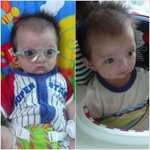 <b>백내장</b>으로 인해 안경 쓴 아기...