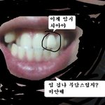 앞에 <b>이빨</b>하나 큰일남 인증샷 有 도와줘 나힘들어. 걱정되미치겠어...