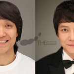 '페이스오프' 개그맨 이방용, 성형 과정 전격 공개