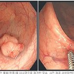 [이대<b>목동</b>병원] 대장암 자가진단 내 똥 알아맞히기 캠페인