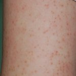 ★★★<b>닭살</b>피부 99.584696%공감★★★★