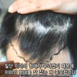 물어보세요 보니까, 탈모는 초기에 용기를 <b>내서</b> 치료를 시작해야 할듯
