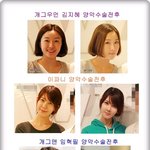 양악수술 관심있는 사람들을 위한 양악수술/양악수술후기/양악수술뉴스