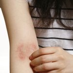 무더운 여름, 아토피 피부염 환자들은 이렇게 이겨내자!