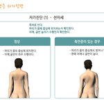 <b>척추</b> 건강 -  척추측만증 자가진단법