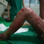 온몸의 피부가 불에 모두 벗겨진 우리 아버지