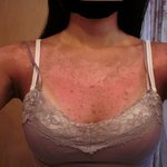 태닝하려구 나대다가 화상입은 사연. 사진有