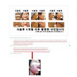 <b>울쎄라</b>시술 부작용과 그효과???조심하세요