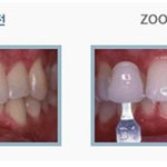 줌 치아<b>미백</b>시스템으로 45분만에 치아<b>미백</b> 