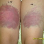 (사진有)  동생이 학원에서 매맞고 왔는데 <b>허벅지</b>가.. 신고했습니다!!