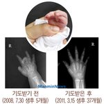 "눈에 넣어도 아프지 않을 아들, 굽은 <b>중지</b>가 펴졌어요"