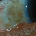 (100%실화) 손톱이 다 뭉개져버린 내친구....