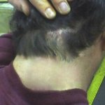 혐오주의   여드름사진 <b>포샵</b>으로없애봄...ㅋㅋㅋㅋㅋㅋㅋ...혐오주의