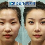 톡톡! 성형의 힘!