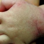 우리아이 아토피 ㅠㅠ <b>육아</b>고수님들 제발 도와주세요 ㅠㅠ엉엉