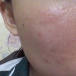 ★★★★★여드름 없애기 도전합니다!★★★★★